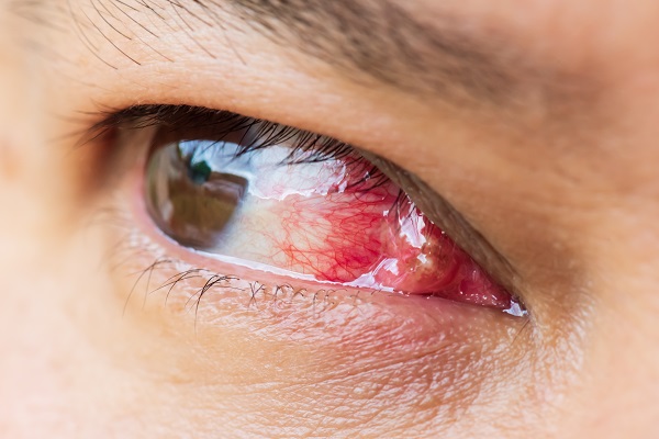 Obstrução da via lacrimal: saiba quando identificar e tratar o problema