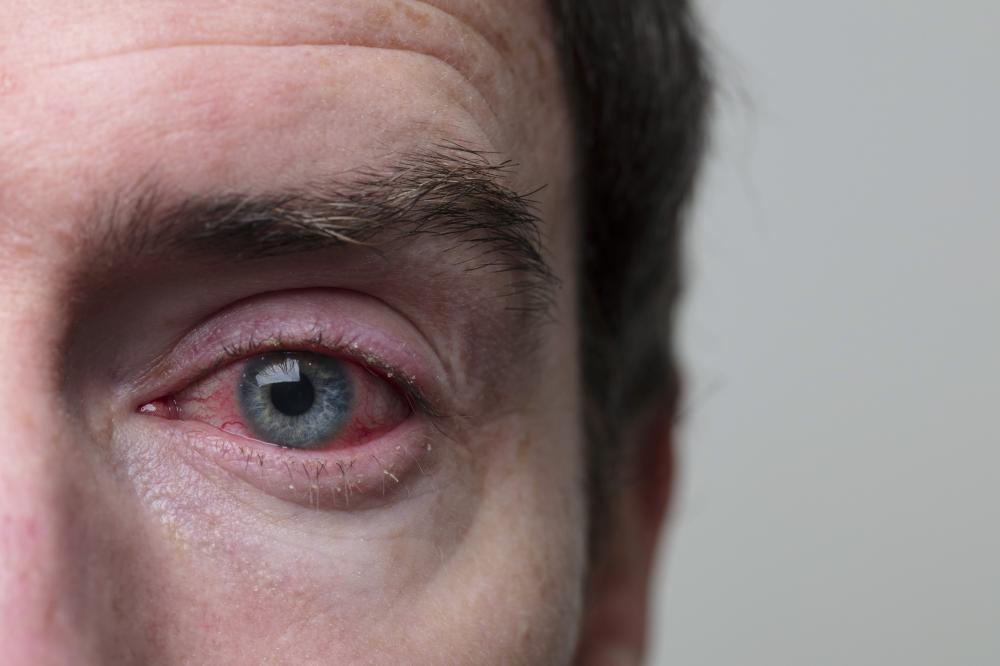 Olhos vermelhos: especialista explica o que esse sintoma pode dizer sobre a saúde ocular