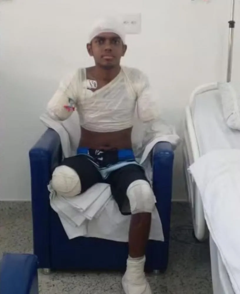 Adolescente tem membros amputados após descarga elétrica de 8 mil volts
