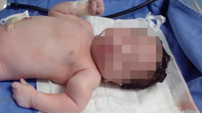 Bebê tem braço quebrado durante parto em Salvador